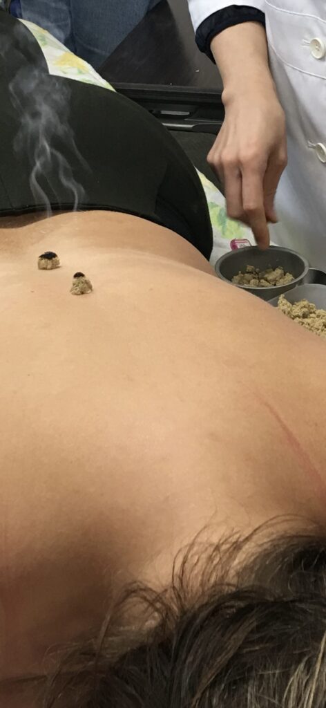 A patient at our Ottawa acupuncture clinic receiving a moxibution treatment on Du4 & Du6 during san fu days to tonify the kidneys & spleen.